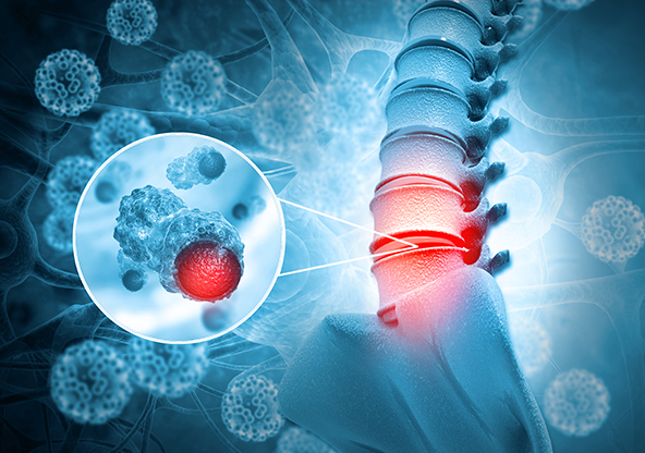 3d illustration of a spinal tumor